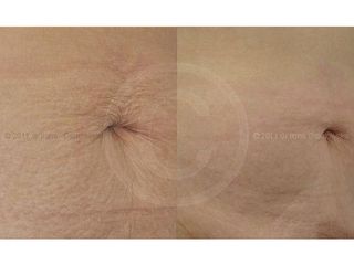 Laser frakcyjny CO2 - Dr Ilona Osadowska