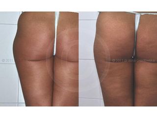 Liposukcja laserowa przed i po.jpg