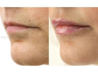 Powiększanie ust kwasem hialuronowym Restylane przed i po.jpg