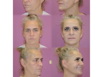 Lifting twarzy przed i po - 878329