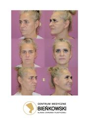 Deep Lift twarz i szyja + plastyka powiek dolnych