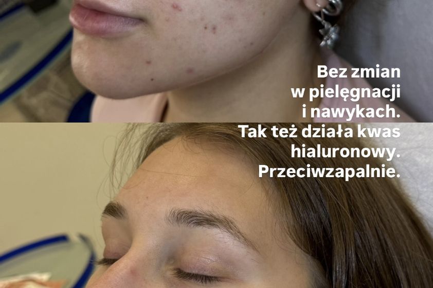 Kwas hialuronowy przed i po - 875662
