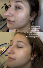 Mezoterapia kwasem hialuronowym - 1 zabige