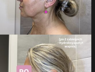 Anti-aging przed i po - 875663