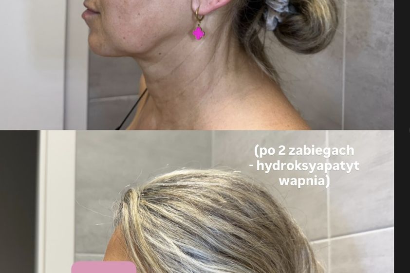 Anti-aging przed i po - 875663