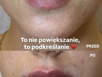 Powiększanie ust przed i po - 875664
