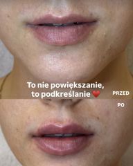 powiększanie ust kwasem hialuronowym