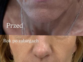 Anti-aging przed i po - 875665