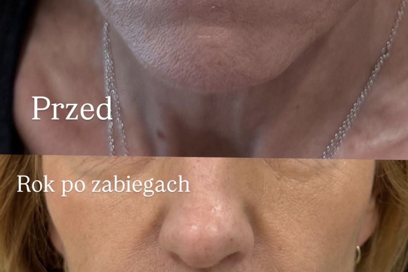 Anti-aging przed i po - 875665