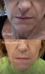 efekt rok po zabiegach
