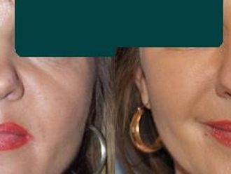 Lipofiling - przeszczep tłuszczu - 653444