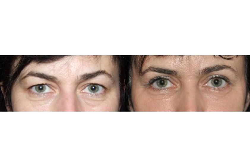 Blefaroplastyka przed i po - 686343
