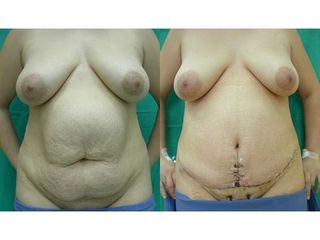 Przed i po: abdominoplastyka