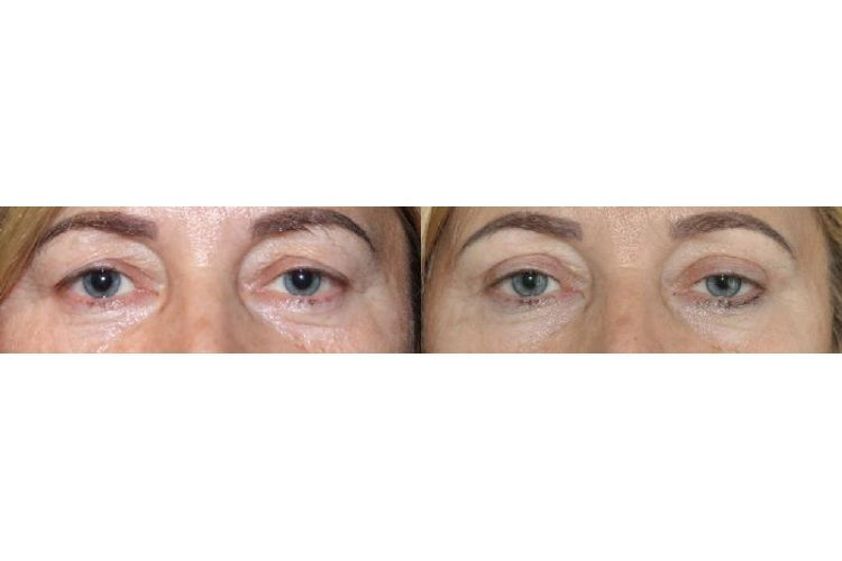 Blefaroplastyka przed i po - 686349