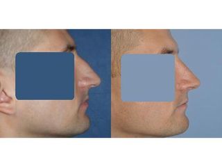 Przed i po: korekcja nosa