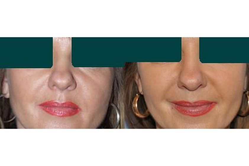 Lipofilling przed i po - 686359