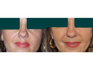 Przed i po: lipofilling twarzy