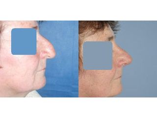 Przed i po: korekcja nosa