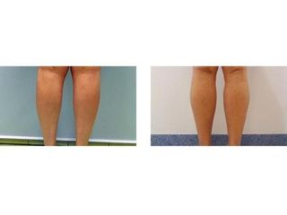 Plastyka łydek implantami -  przed i po