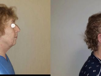 Facelift, Lifting twarzy (podciąganie powłok twarzy) - 659140