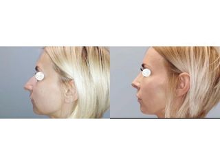 Korekcja nosa  - przed i 8 miesięcy po