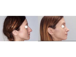 Korekcja nosa  - przed i 1 miesiąc po