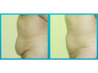 Abdominoplastyka - przed i po