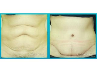 Abdominoplastyka - przed i po