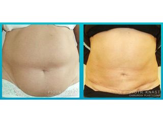 Abdominoplastyka - przed i po