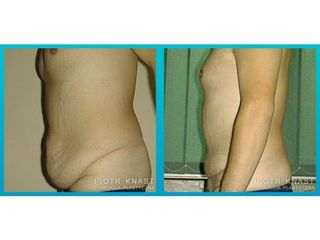 Abdominoplastyka - przed i po