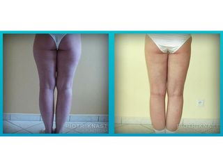 Lipofilling - przed i po