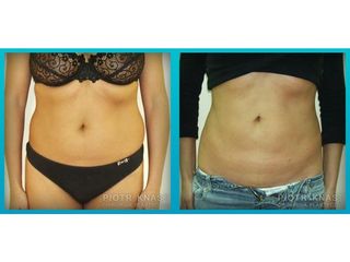 Abdominoplastyka - przed i po