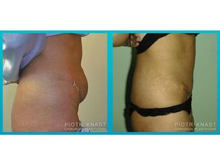 Abdominoplastyka - przed i po