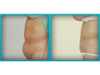 Abdominoplastyka - przed i po