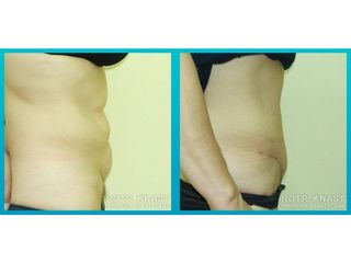 Abdominoplastyka - przed i po