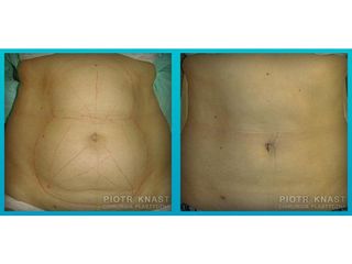 Abdominoplastyka - przed i po