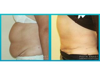 Abdominoplastyka - przed i po