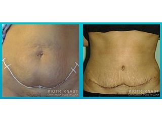 Abdominoplastyka - przed i po