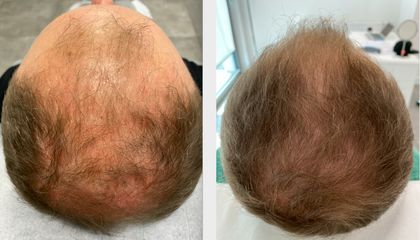 Leczenie łysienia - przed i po