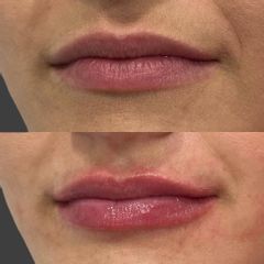 Powiększanie ust - dr Magdalena Potembska-Eberhardt