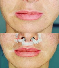 Lip lift - DR GZIUT