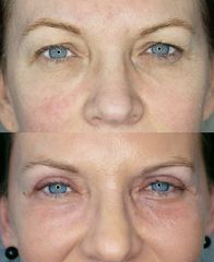 Blefaroplastyka - DR GZIUT