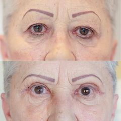 Blefaroplastyka - DR GZIUT