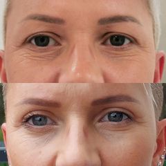 Blefaroplastyka - DR GZIUT