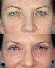 Blefaroplastyka - DR GZIUT