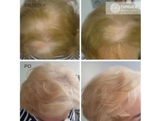 Przeszczep włosów u kobiety - przed i po