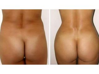 Powiększanie i modelowanie pośladków - przed i po