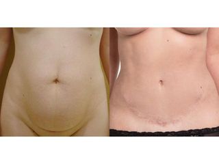 Liposukcja Vaser Lipo, operacja przepukliny kresy białej i podniesienie powłok brzucha - przed i po