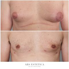 Ginekomastia - Dr n. med. Wojciech Rybak