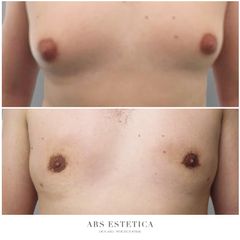 Ginekomastia - Dr n. med. Wojciech Rybak